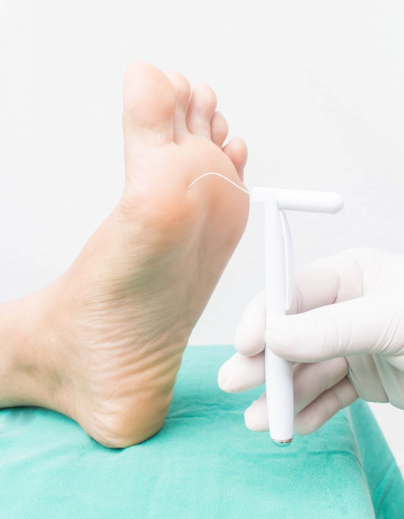 Diabetic foot neuropathy treatment